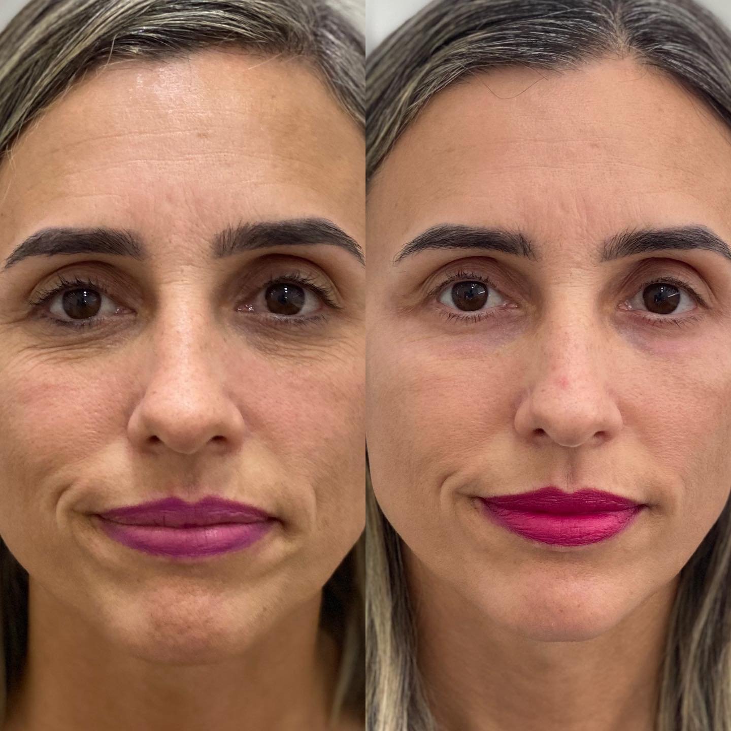 Harmonização Facial